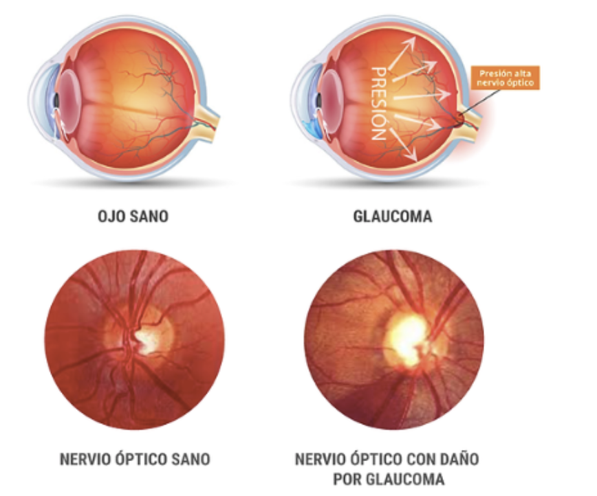 Glaucoma