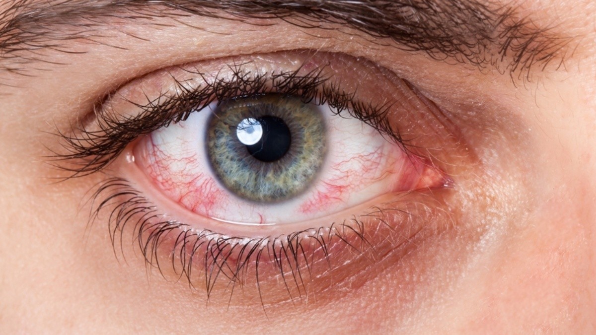 ojo rojo